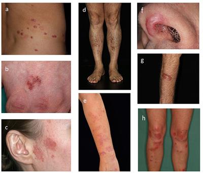 Evaluation of clinical and laboratory characteristics of patients with cutaneous sarcoidosis: A single-center retrospective cohort study